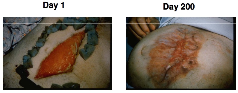 Non-healing aterial transplant wound treated with Activated Carbon Cloth