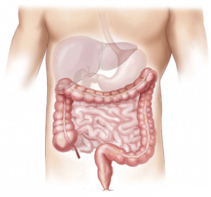 Colitis Intestinal System