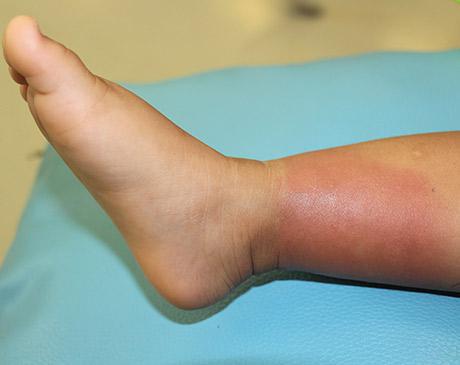 cellulitis