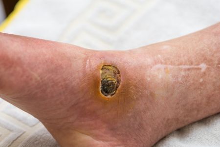 foot ulcer