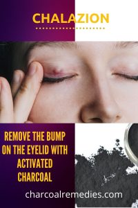 activated charcoal for chalazion treatment 1