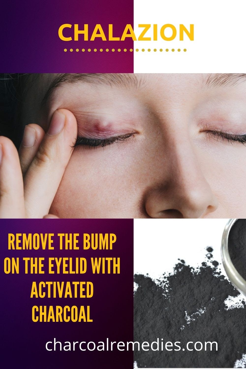  1 Natural Chalazion Treatment Charcoal Remedies