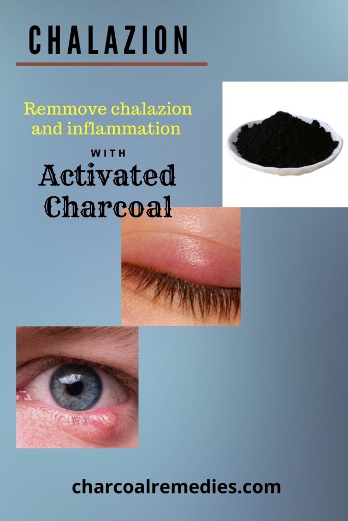  1 Natural Chalazion Treatment Charcoal Remedies