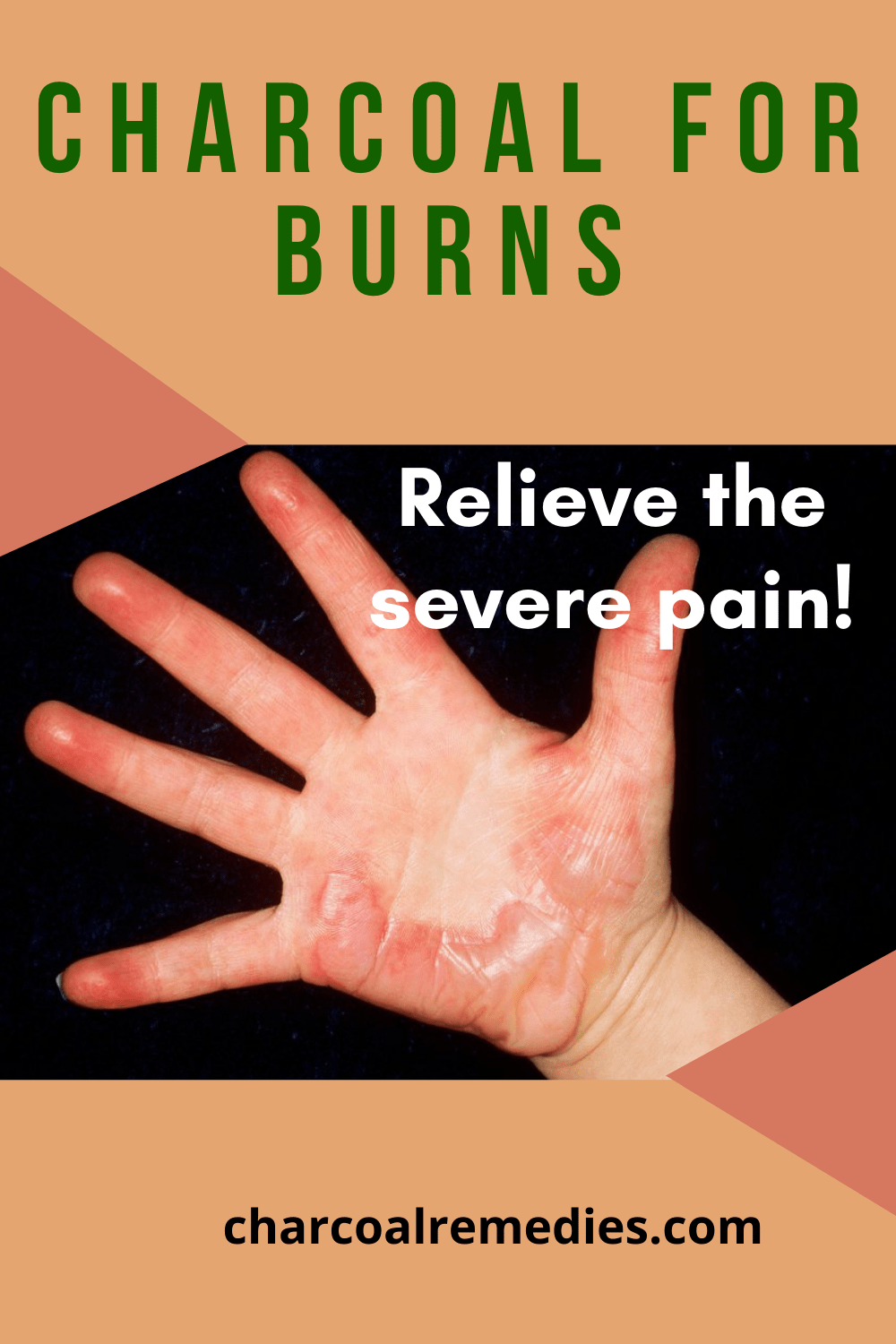 Burns Charcoal Remedies