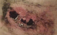 Photo 4 of boiling water burn. The flesh is still pink where the burn happened. Activated charcoal is covering the wound's shallow cavities, and in those areas, the wound is black. 