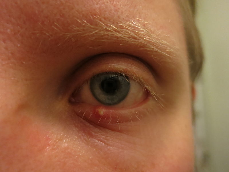 How to Get Rid of a Stye: Medications and At-Home Care