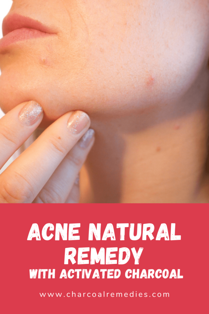 Acne Natural Remedy With Activated Charcoal
