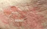 Photo of hot water burn on stomach right after the incident happened. Burn is approximately three inches by three inches. 