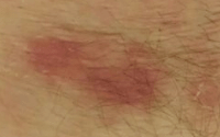 The wound has healed, but a small area of pink is still visible. 