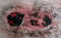 Photo 5. In this photo the wound is still pink for the most part, with areas of black where activated charcoal has been applied. 