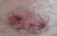 Picture 7. Little specs of activated charcoal are still visible, the wound is a dry pink.