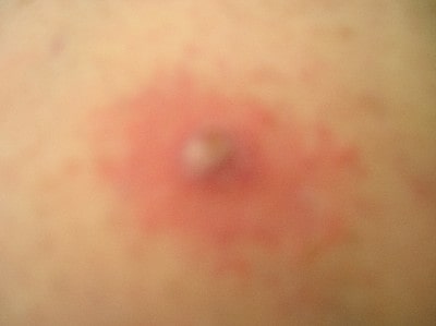 Photo of suspected brown recluse bite before activated charcoal treatment.