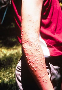 Fire Ants Bites