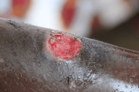 Photo of a necrotizing wound. A close up of a red wound on a limb. The photo is too close to tell if it is an arm or a leg. The surrounding portions of the wound are black for about an inch, and the wound is approximately an inch in diameter, and circular.  