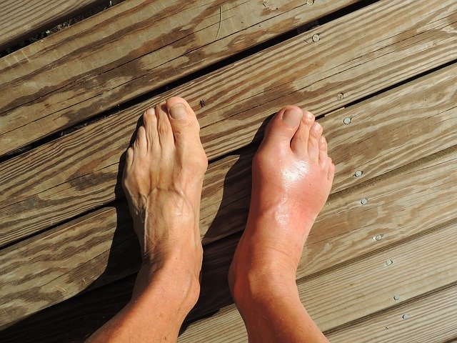 gout feet