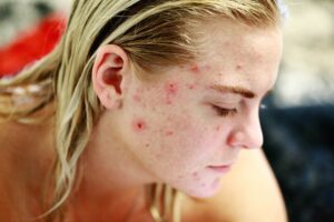 woman with acne