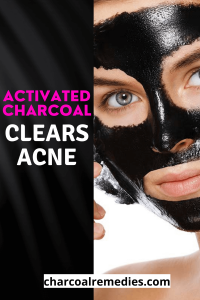 Acne Treatment With Activated Charcoal
