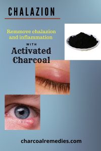activated charcoal for chalazion treatment 3