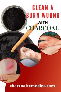 burn treatment with activated charcoal 2