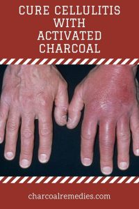 activated charcoal for cellulitis 1