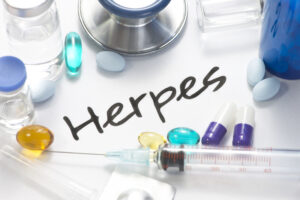 Herpes Treatments
